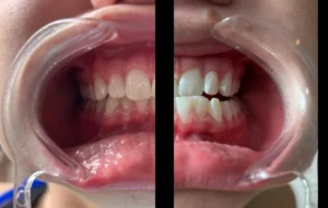 Des Moines Cosmetic Teeth Whitening, the best one session results